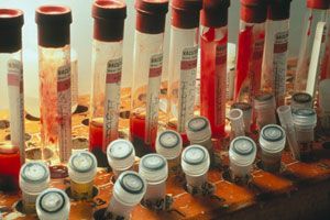 Creutzfeldt Jakob Krankheit Womoglich Durch Blut Ubertragbar Neurologie Derstandard At Gesundheit