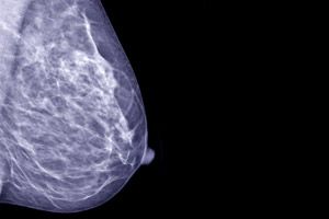 Dichtes gewebe in der brust