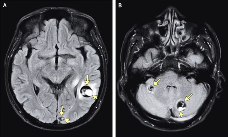 Zwei MRT-Bilder des Gehirns zeigen mit gelben Pfeilen markierte Läsionen, die auf Neurozystizerkose (Infektion durch Bandwurmlarven) hinweisen. Bild A zeigt Läsionen in der rechten Gehirnhälfte, Bild B zeigt Läsionen im Kleinhirn.