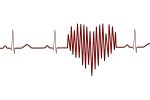 Hattet ihr schon eine Herzkatheterablation?
