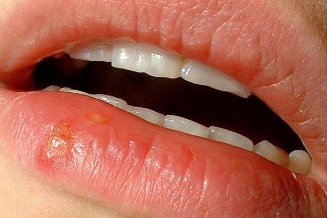 Mund herpes heilt nicht am Herpes: Ursachen,