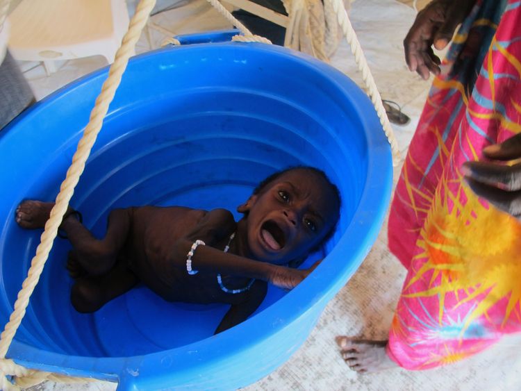 Mogadischu 2011: Ein unterernährtes somalisches Baby wird gewogen