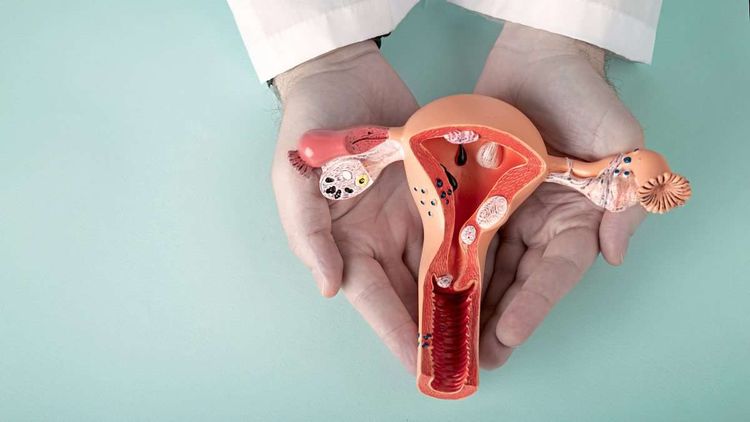 Modell einer Gebärmutter mit Endometriose