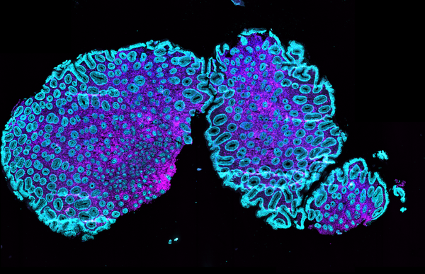 Wie-vergangene-Entz-ndungen-zur-Krebsentstehung-beitragen-k-nnen