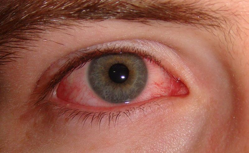 Bindehautentzündung: Antibiotische Augentropfen oft unnötig