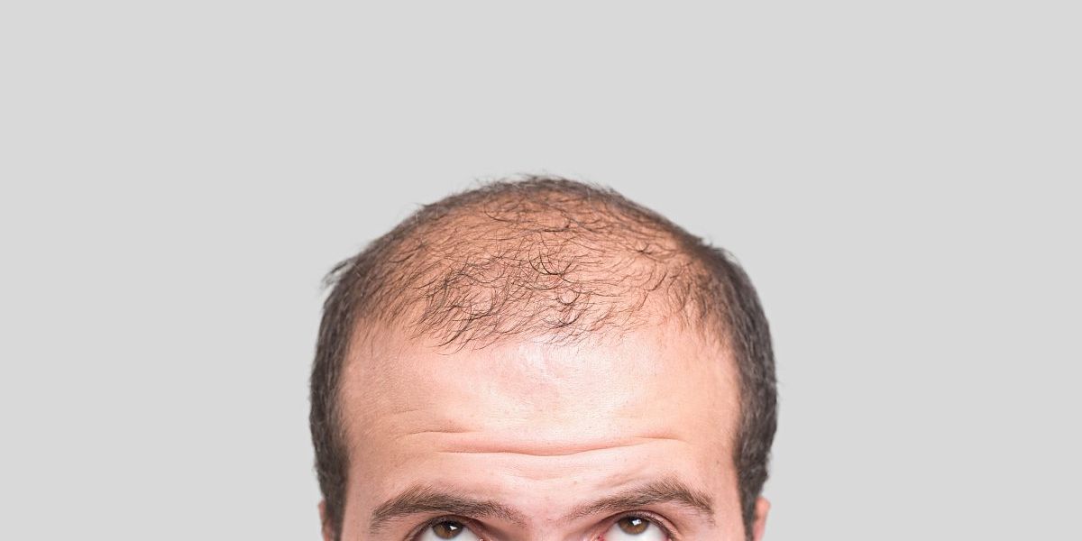 Mit 25 glatze Medizin: Haarausfall