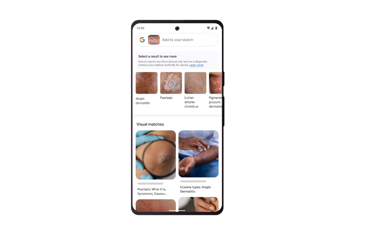 Google Lens erkennt Hautkrankheiten