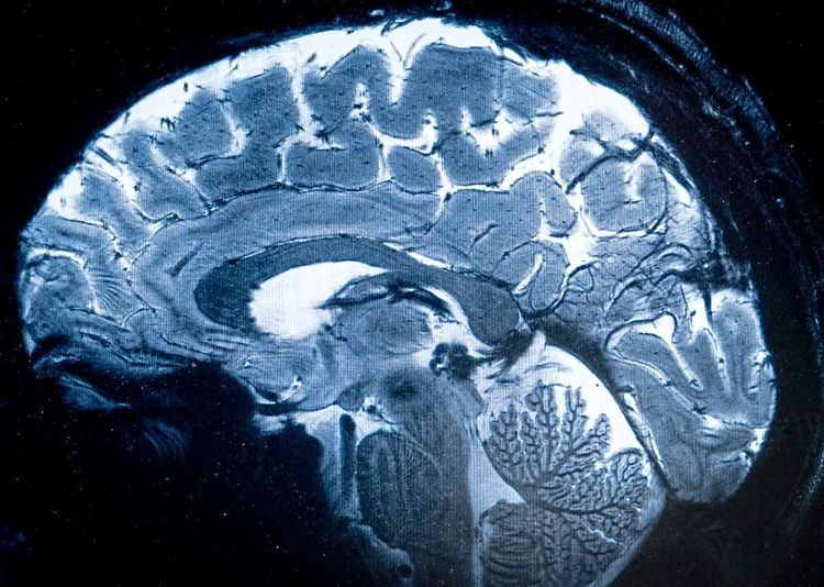 MRI, Gehirn