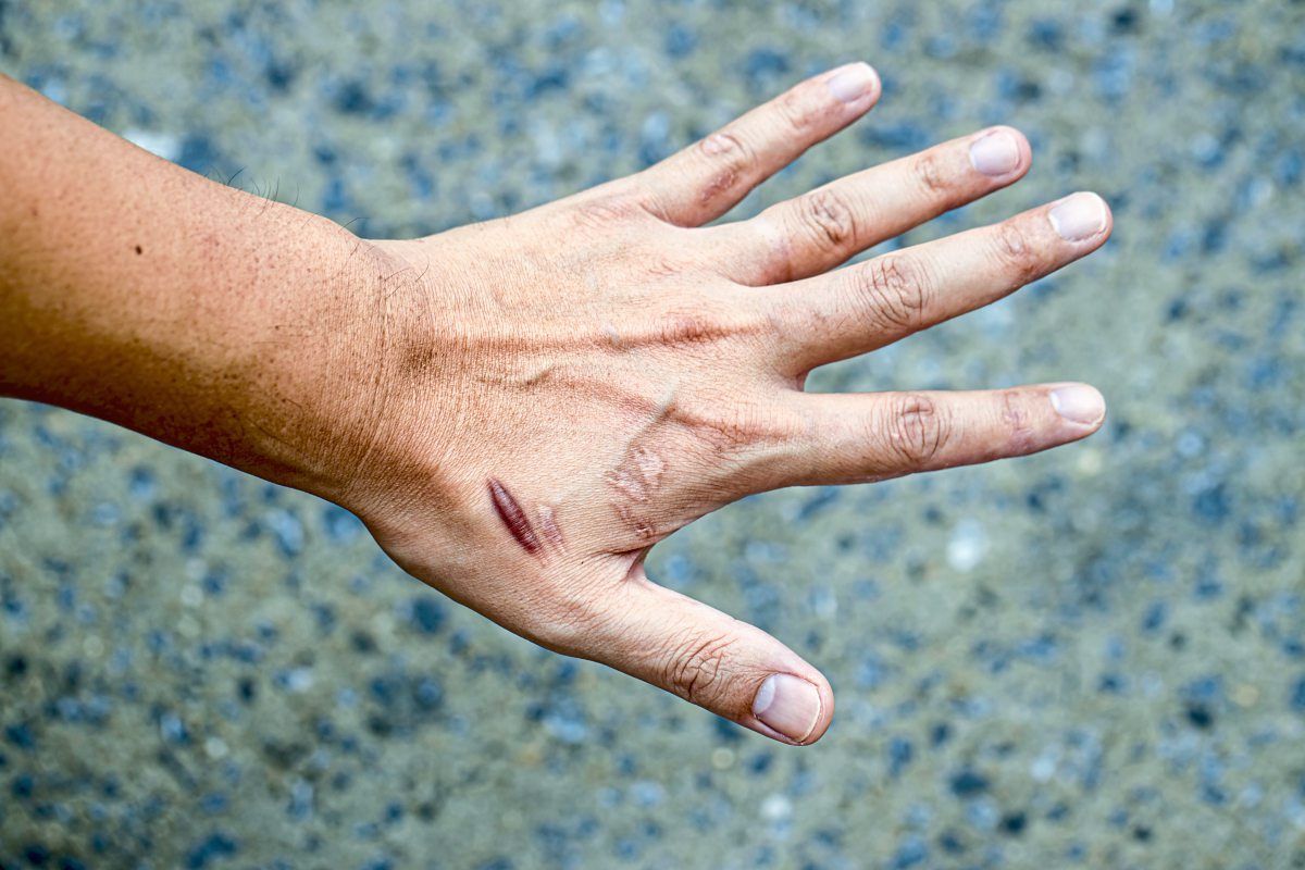 Was kann man tun, wenn Narben schmerzen oder stören? Gesundheit derStandard.de › Wissen und